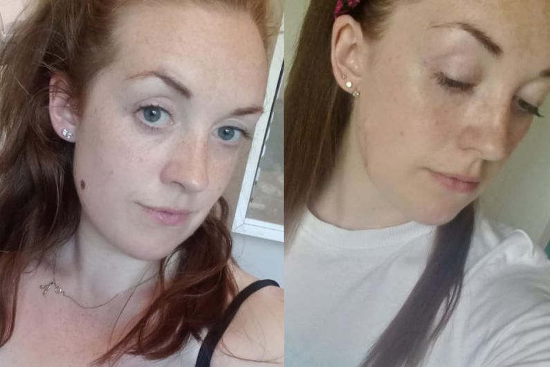 Cavan woman urges people to be sun smart after skin cancer diagnosis