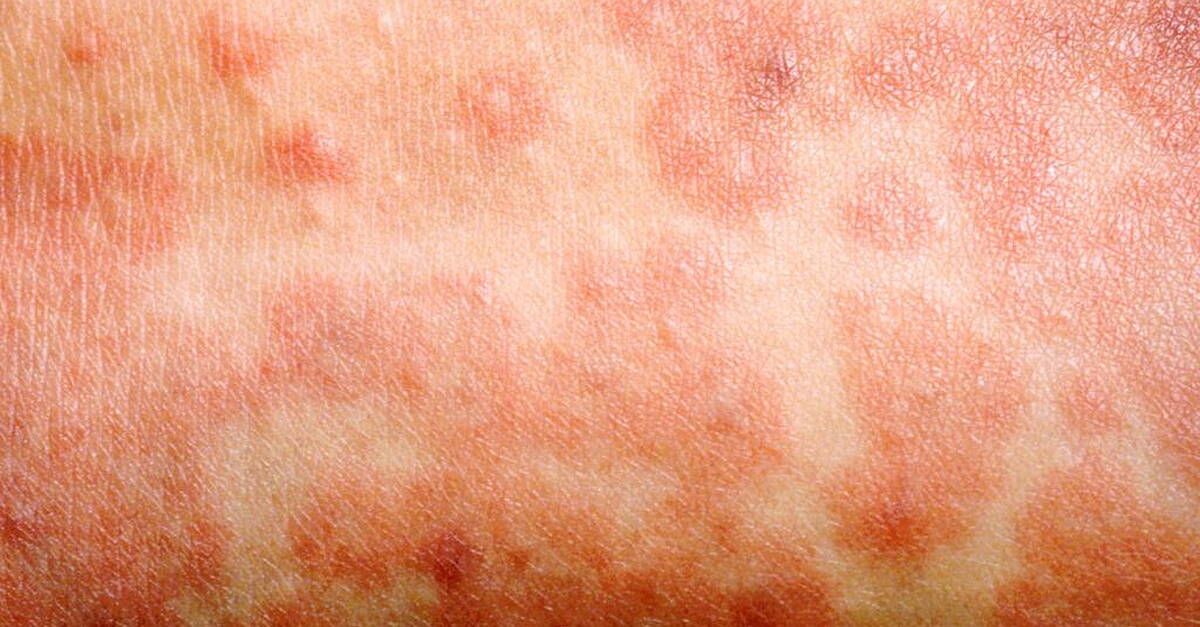 Kerry region public medicine consultant says Ireland is victim of its own success when it comes to measles - Vimarsana News