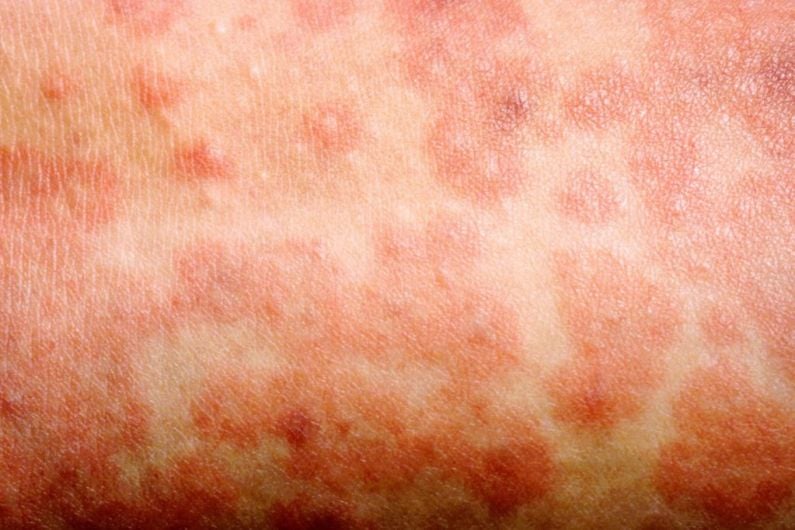 14 cases of measles confirmed in South West region this year