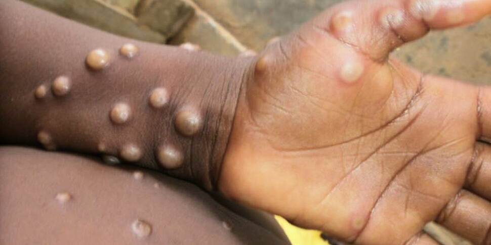 First Monkeypox Case Identifie...