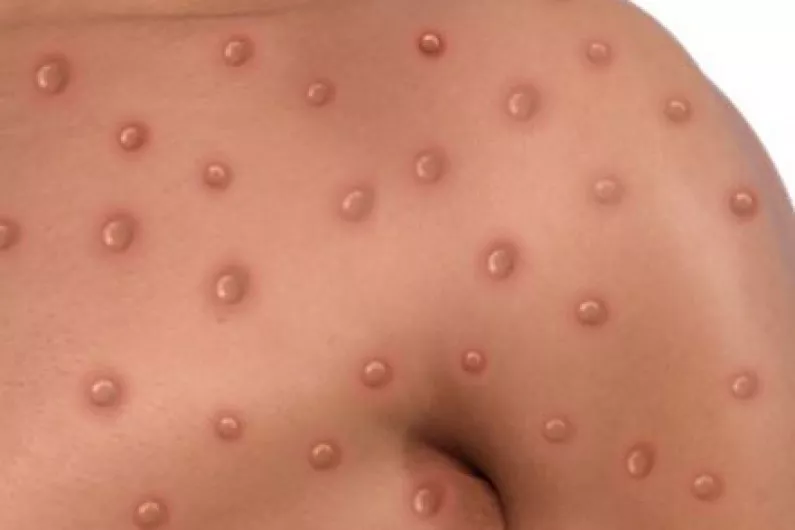 Roscommon records no cases of monkeypox so far this year