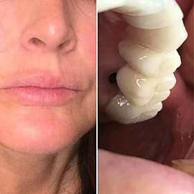 Woman to have ‘all teeth removed’ after botched dental procedure abroad Image