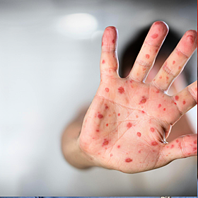 How to spot measles and what to do if you’re sick Image