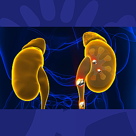 Are Kidney Stones More Painful Than Child Birth? Image