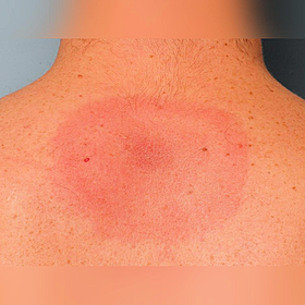 Do we have proper treatment for Lyme disease in Ireland? Image