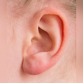 Kids Health Check: Ear Infections Image