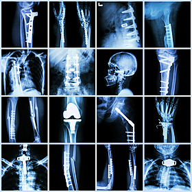A new Spanish hospital to accommodate Irish patients waiting on orthopedic treatments Image