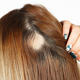 Coping with Alopecia Image