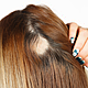 Coping with Alopecia