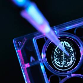 'Whole system shift' required to introduce Alzheimer's drug in Ireland Image