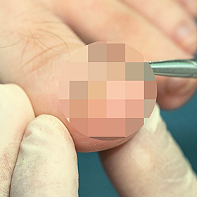 How to prevent and deal with an ingrown toenail Image