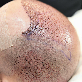 Getting a hair transplant: 'I didn't leave the house without a hat' Image
