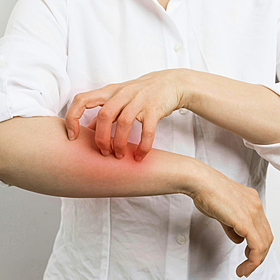 What is scabies and why are outbreaks rising? Image