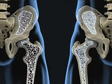 Osteoporosis test developed at UL to benefit millions of people