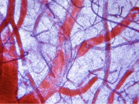 Novel way to quickly find blocked arteries discovered