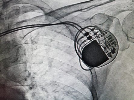 FDA warns that hackers can attack pacemakers and kill patients
