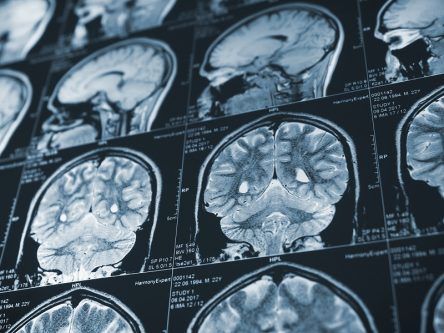 US approves Alzheimer’s drug designed to slow cognitive decline