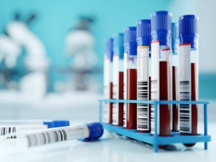 UCD research may predict severity of Covid-19 from blood tests