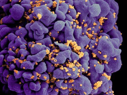 US scientists report third case of HIV remission from stem cell treatment