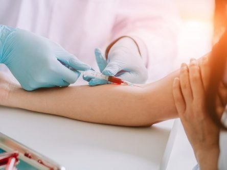DCU-led blood test study could boost breast cancer treatment
