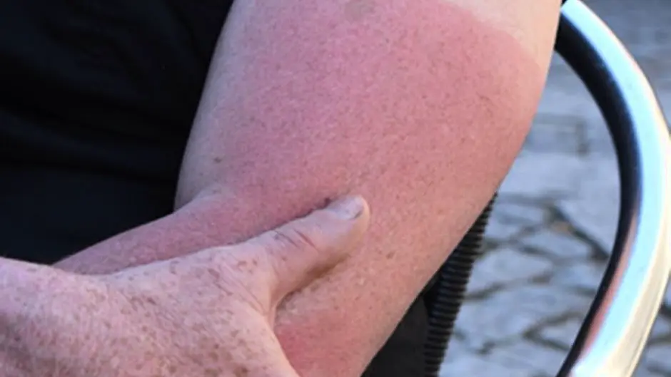 IFA joins Cancer Society to remind farmers of sun risks Image