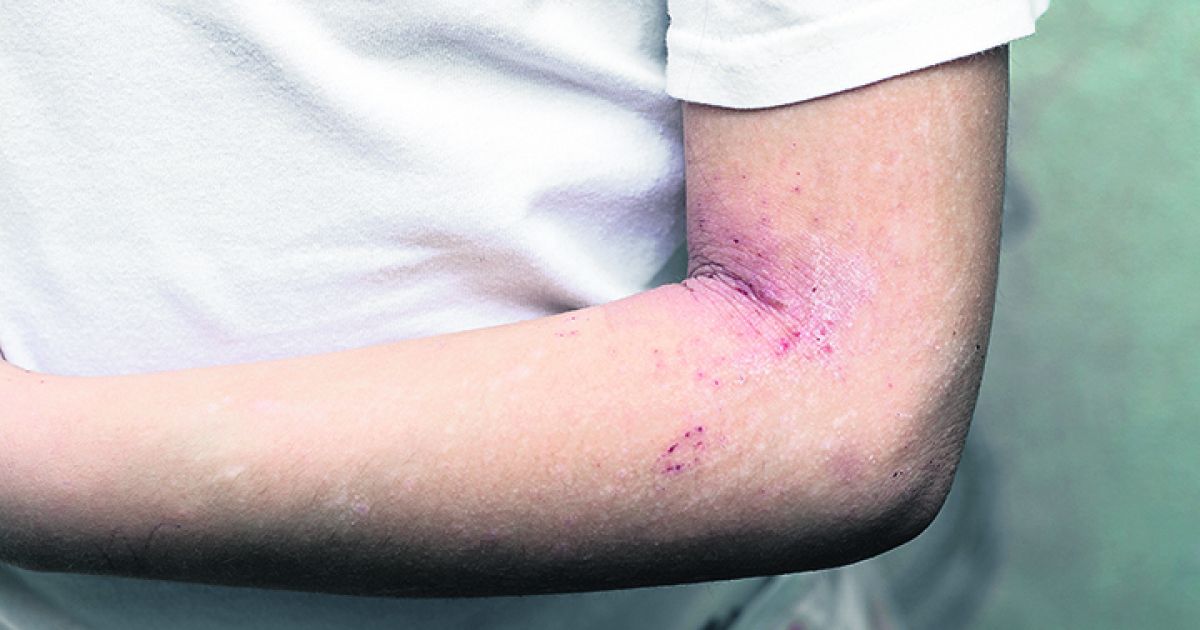 Health Scratching The Surface Of Eczema Problems Southern Star