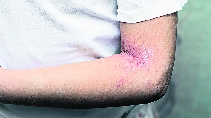HEALTH: Scratching the surface of eczema problems Image