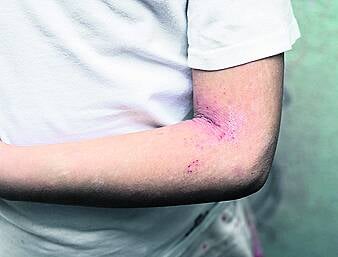 HEALTH: Scratching the surface of eczema problems Image