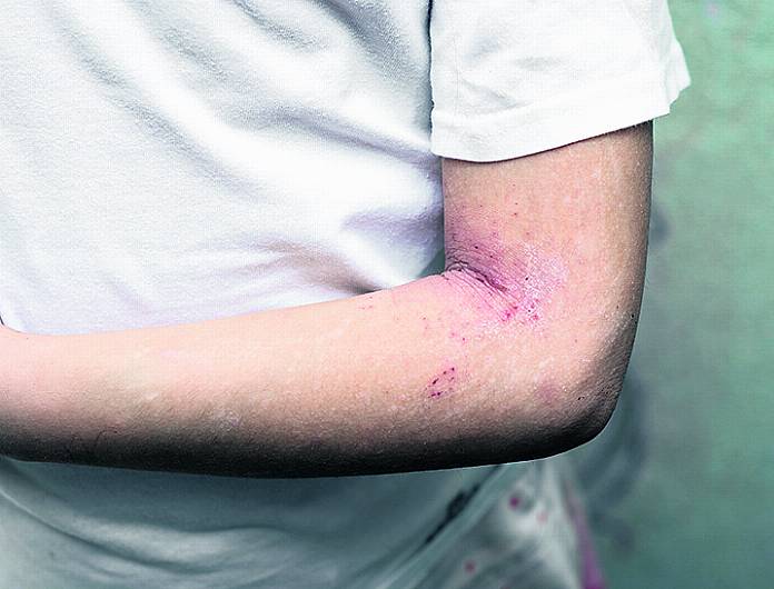 HEALTH: Scratching the surface of eczema problems Image