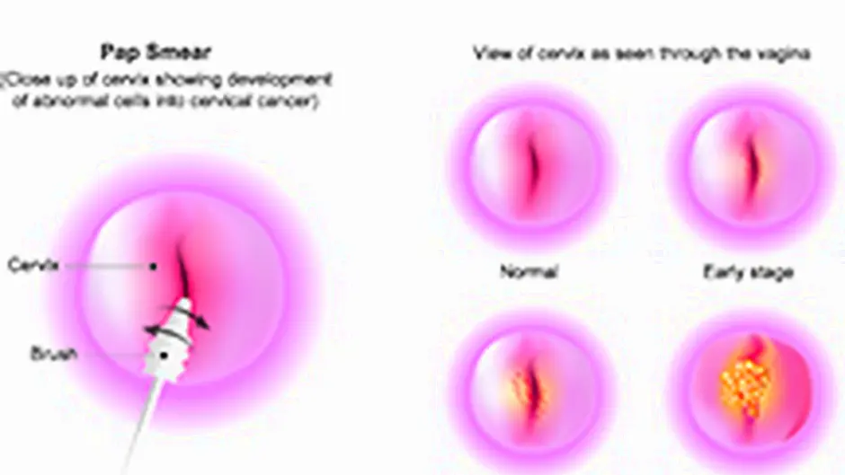 Delay of 8 months for smear test results here Image