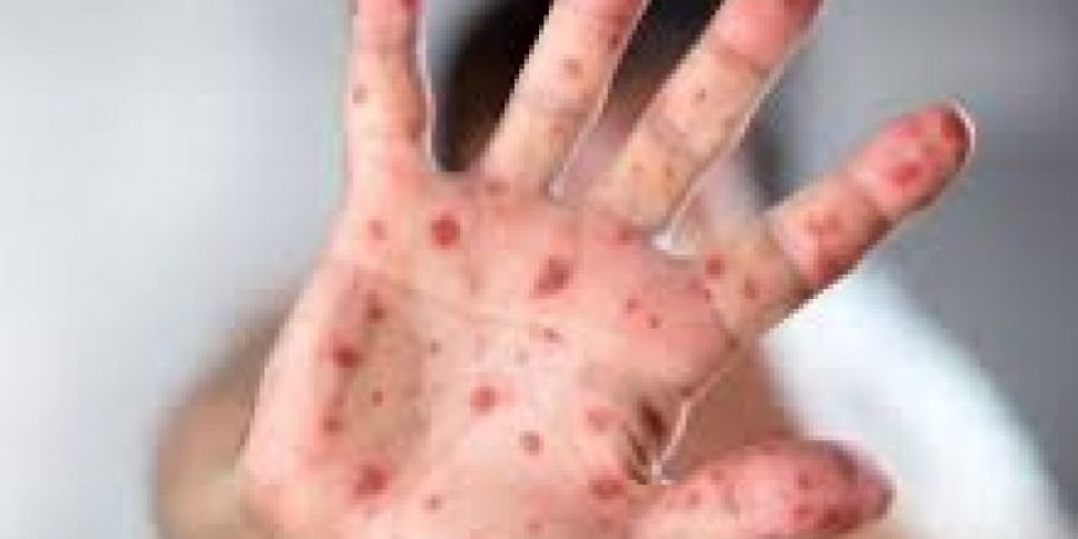 Outbreak Of Measles Confirmed...