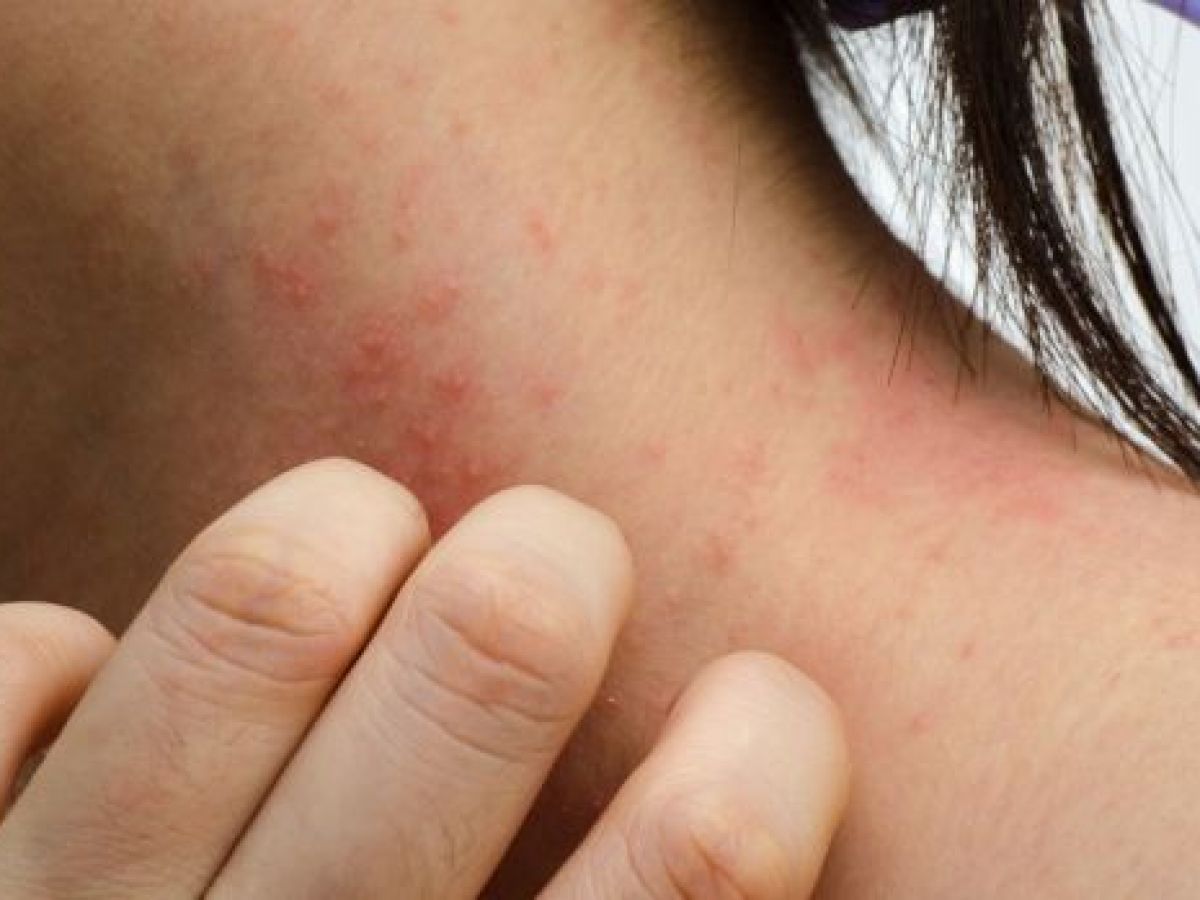 What Is Eczema And How Can It Be Treated?