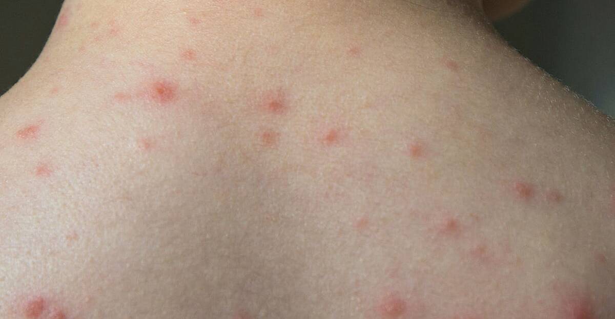 How To Spot And Treat Chickenpox