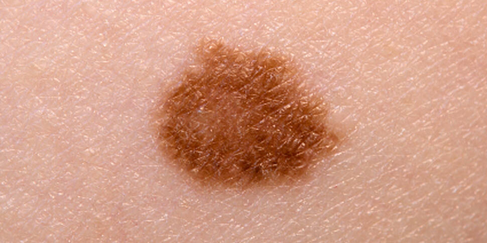 why-it-s-important-to-get-your-moles-checked-out