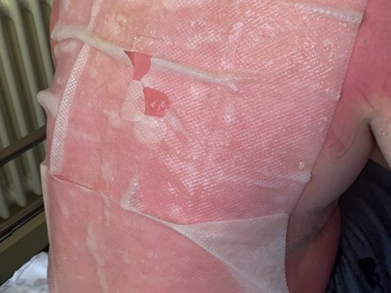 Mother issues warning after son suffers second-degree burns despite suncream