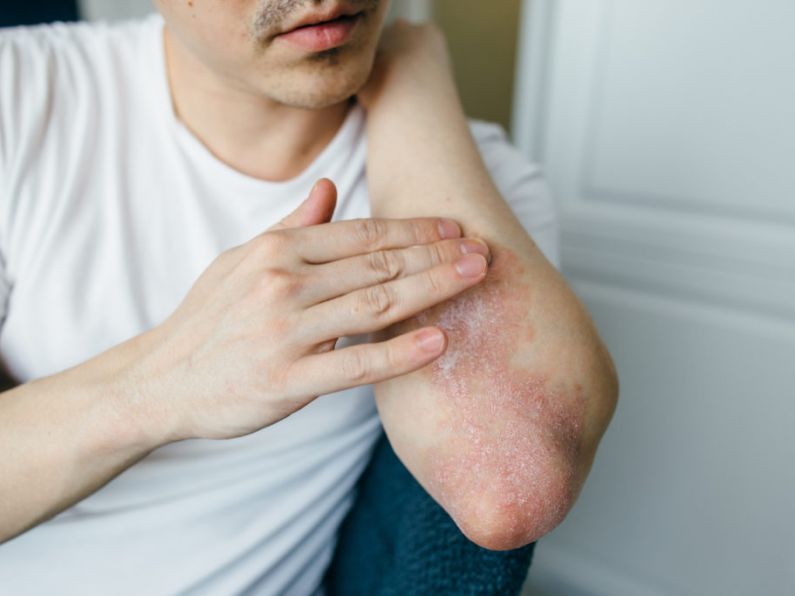 Research of people with the Psoriasis skin condition
