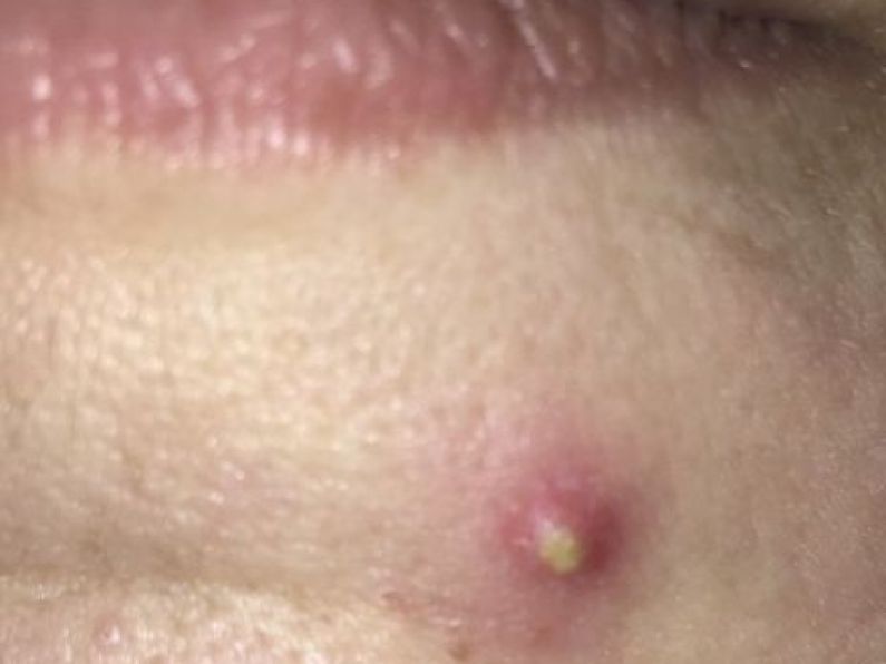Listen: Dr Austin Byrne talks acne!