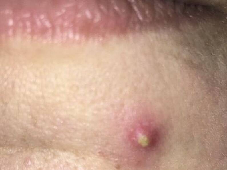 Listen: Dr Austin Byrne talks acne!